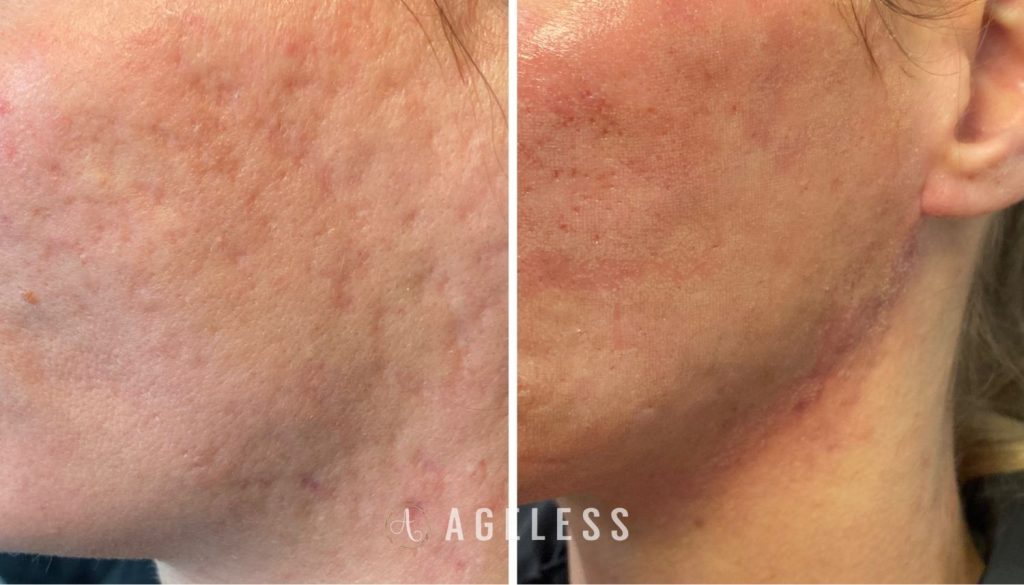 Co2 Laser before and after