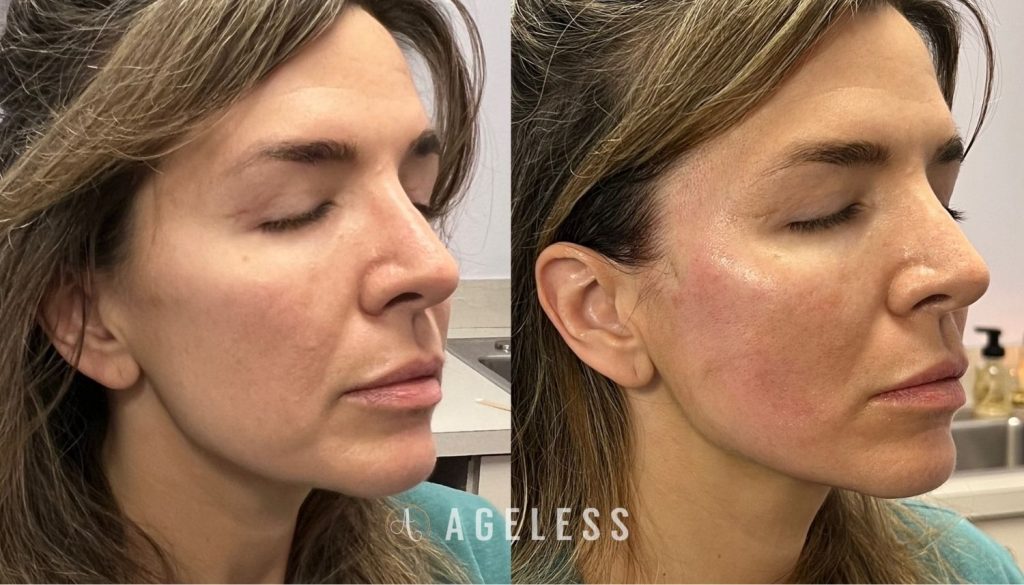 PDO Thread Lift before and after