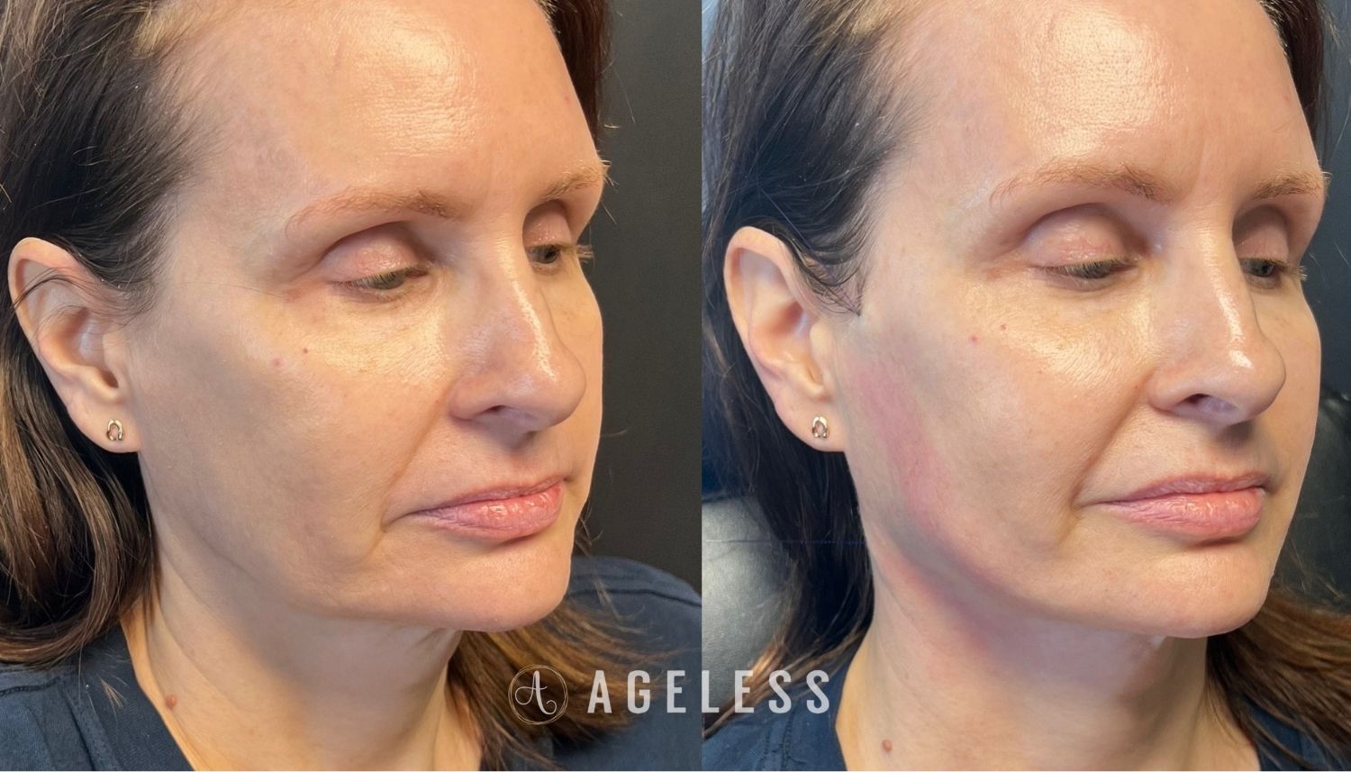 PDO Threads jowls before and after