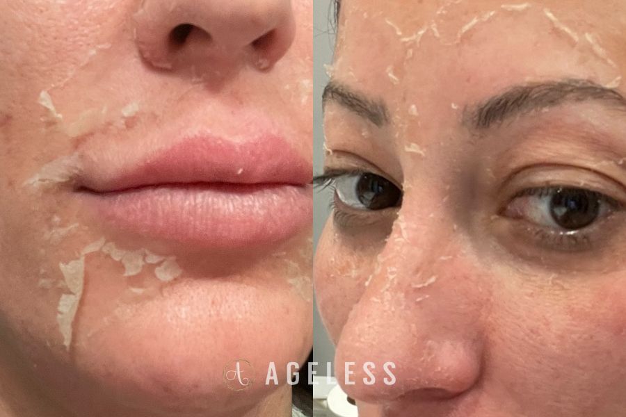 VI Peel Peeling Stage