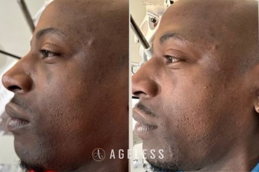 VI Peel before and after