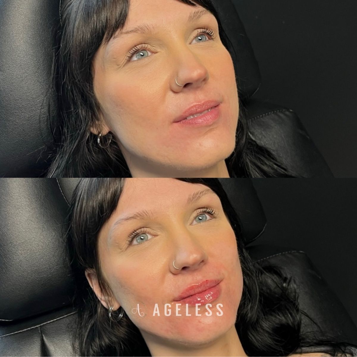Lip filler before and after
