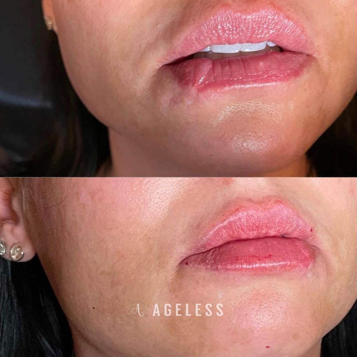 Scar revision filler before and after