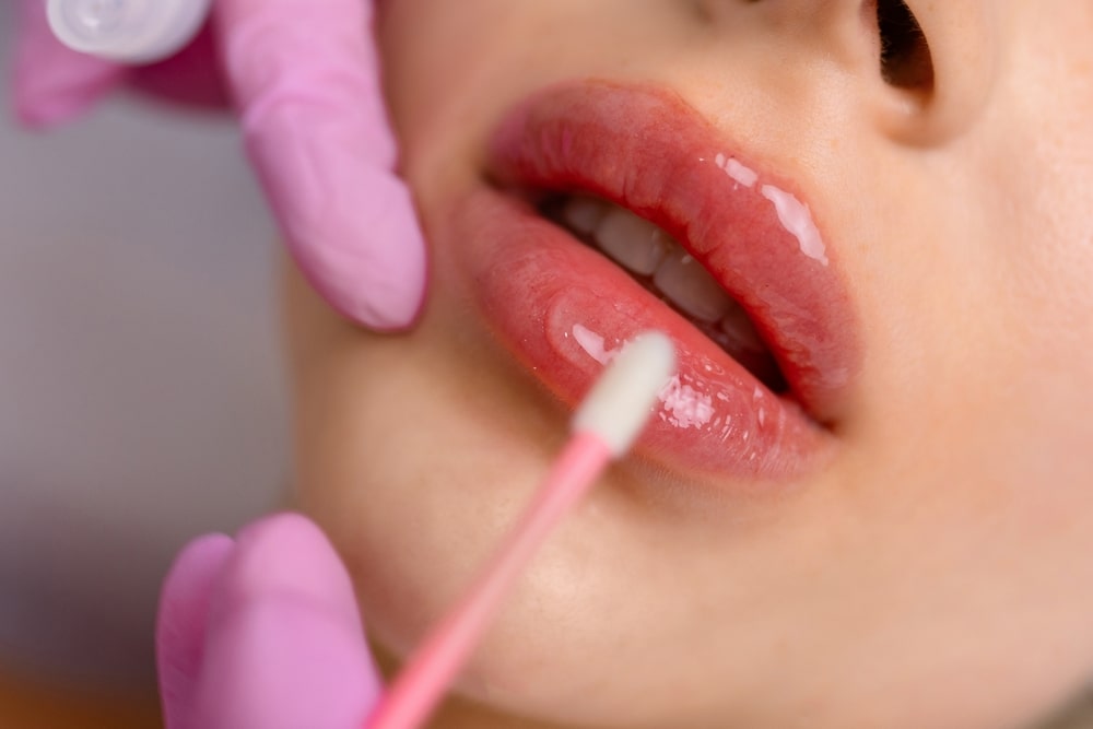 lip filler