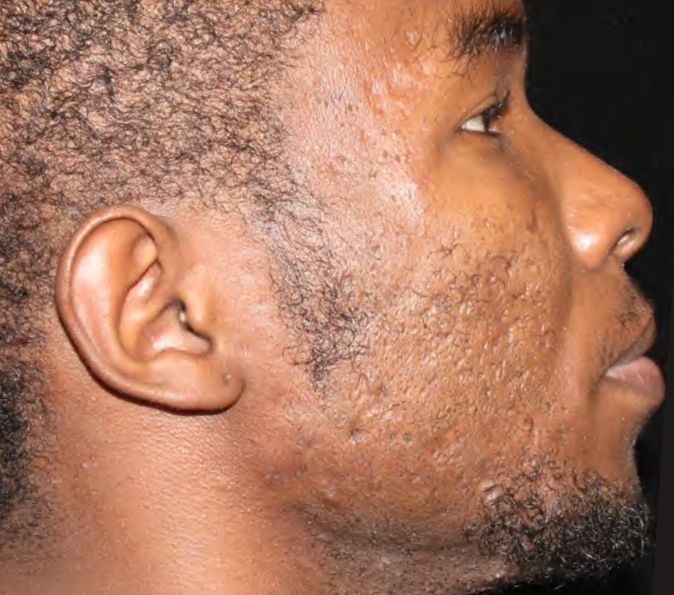 acne scars after 2 sofwave treatments