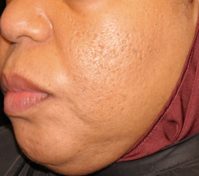 acne scars after 4 sofwave treatments
