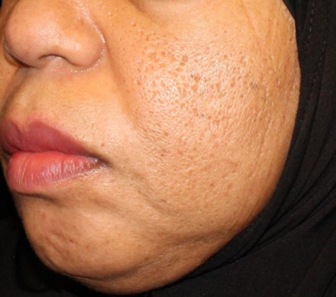 Acne scars before Sofwave