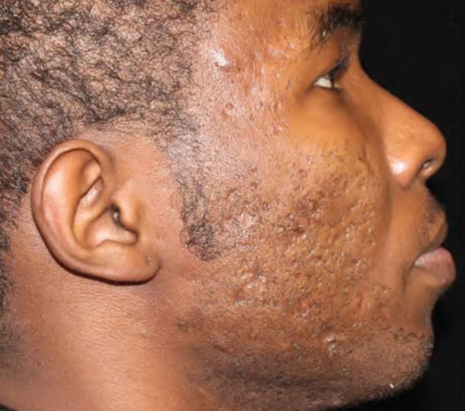 Acne scars before Sofwave
