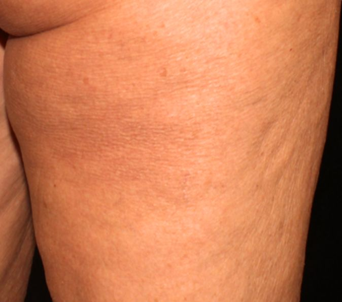 thigh cellulite 4 weeks after Sofwave