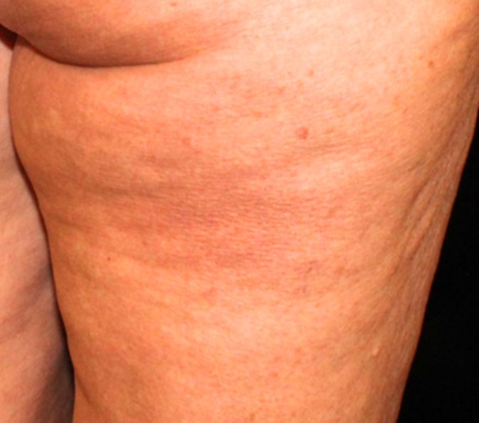 thigh cellulite before Sofwave