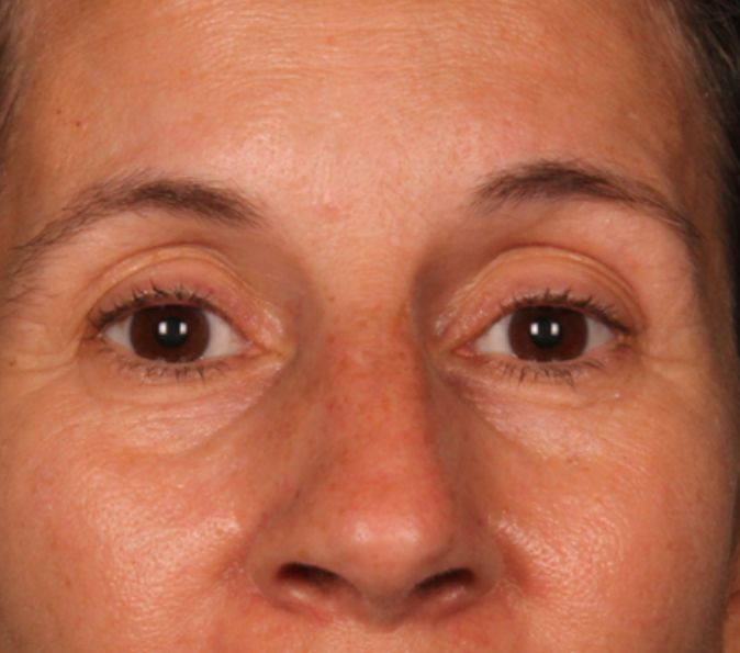 eyes after Sofwave