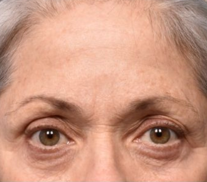 eyes after Sofwave