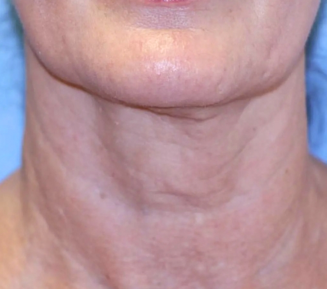 neck after Sofwave