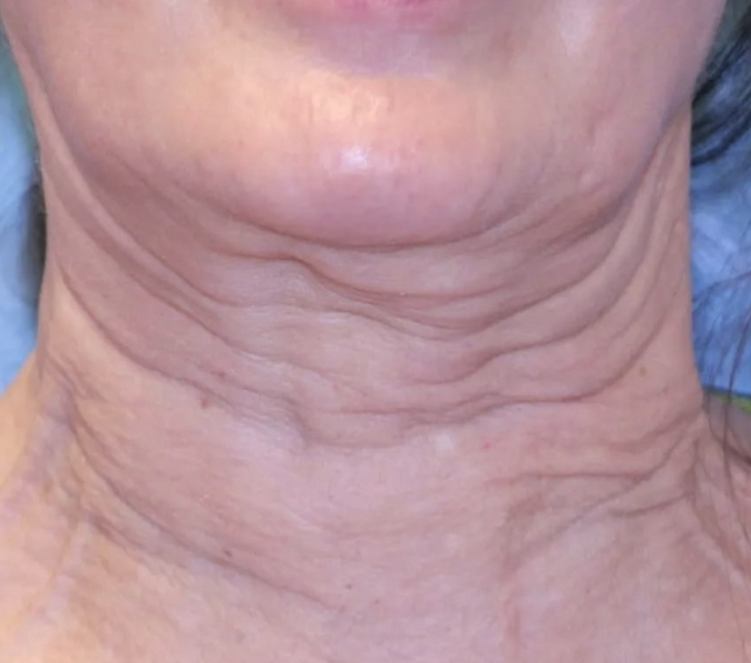 Neck before Sofwave