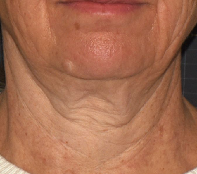 Neck before Sofwave