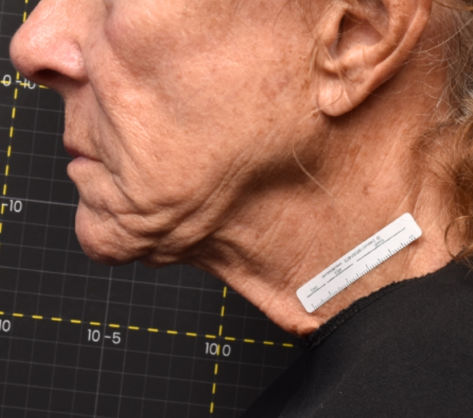 submental fat before Sofwave