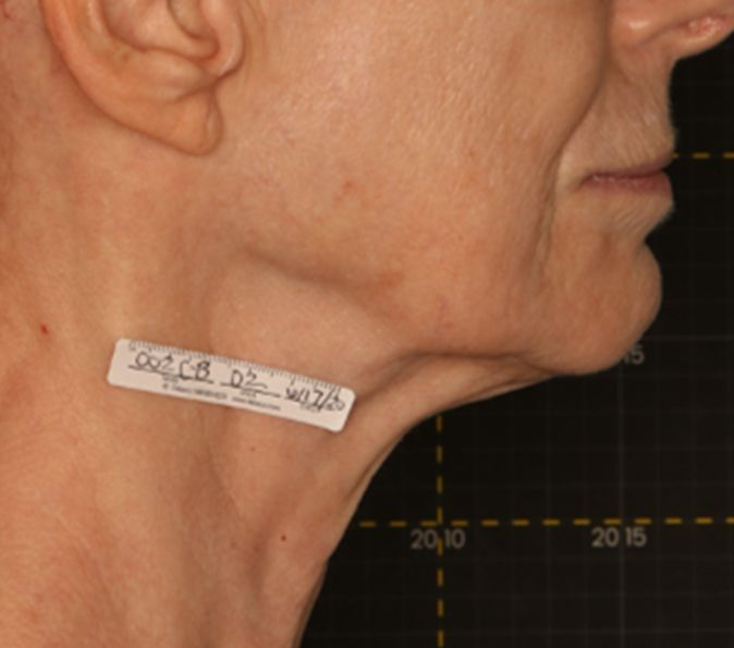submental fat 6 months after Sofwave