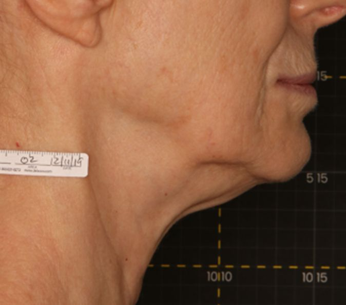 submental fat before Sofwave