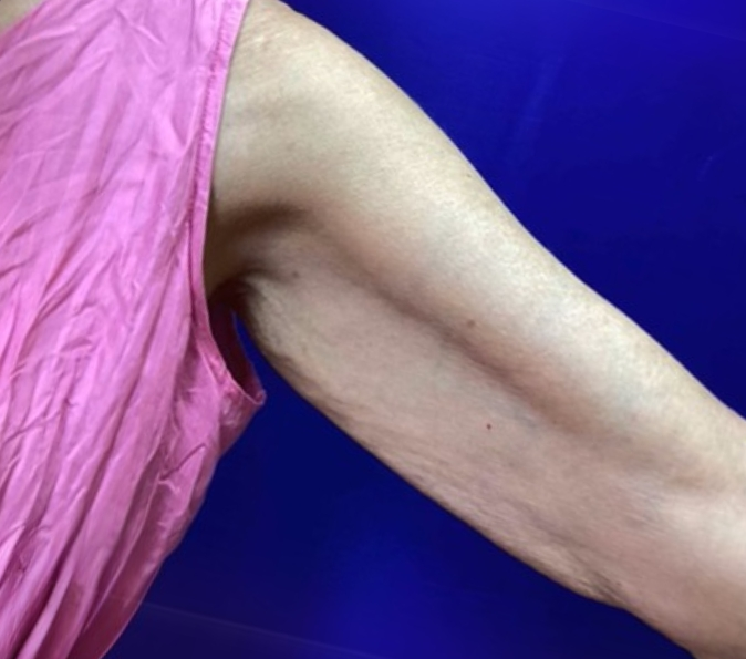 arms after Sofwave