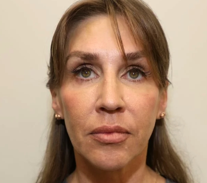wrinkles after Sofwave